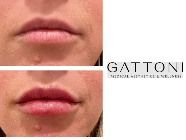 Example of Botox in Denver