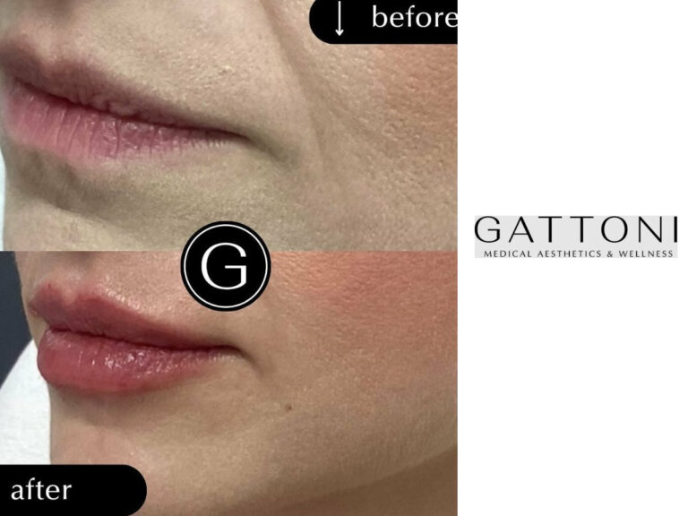 Example of Lip filler in Denver