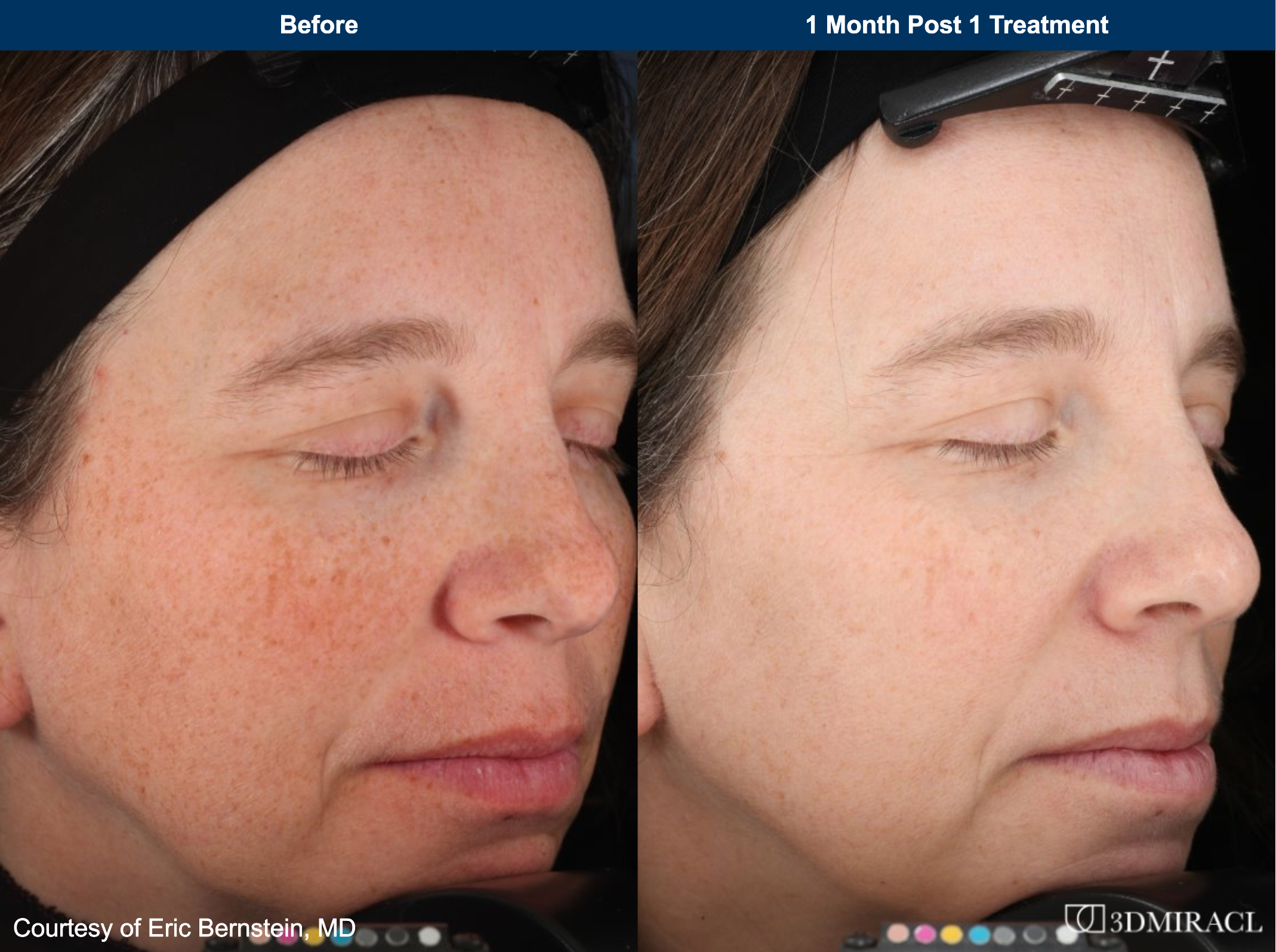 A before and after of an older white woman using UltraClear
