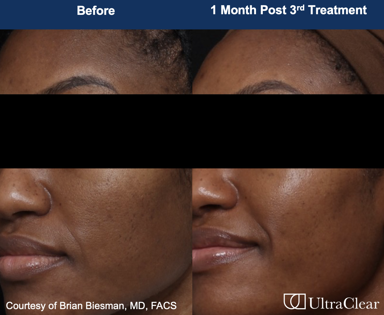 A before and after of an older black woman using UltraClear