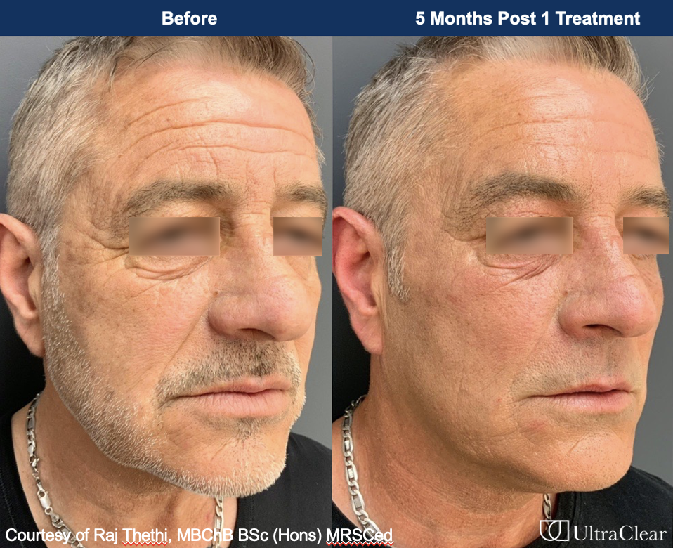 A before and after of an older white man using UltraClear