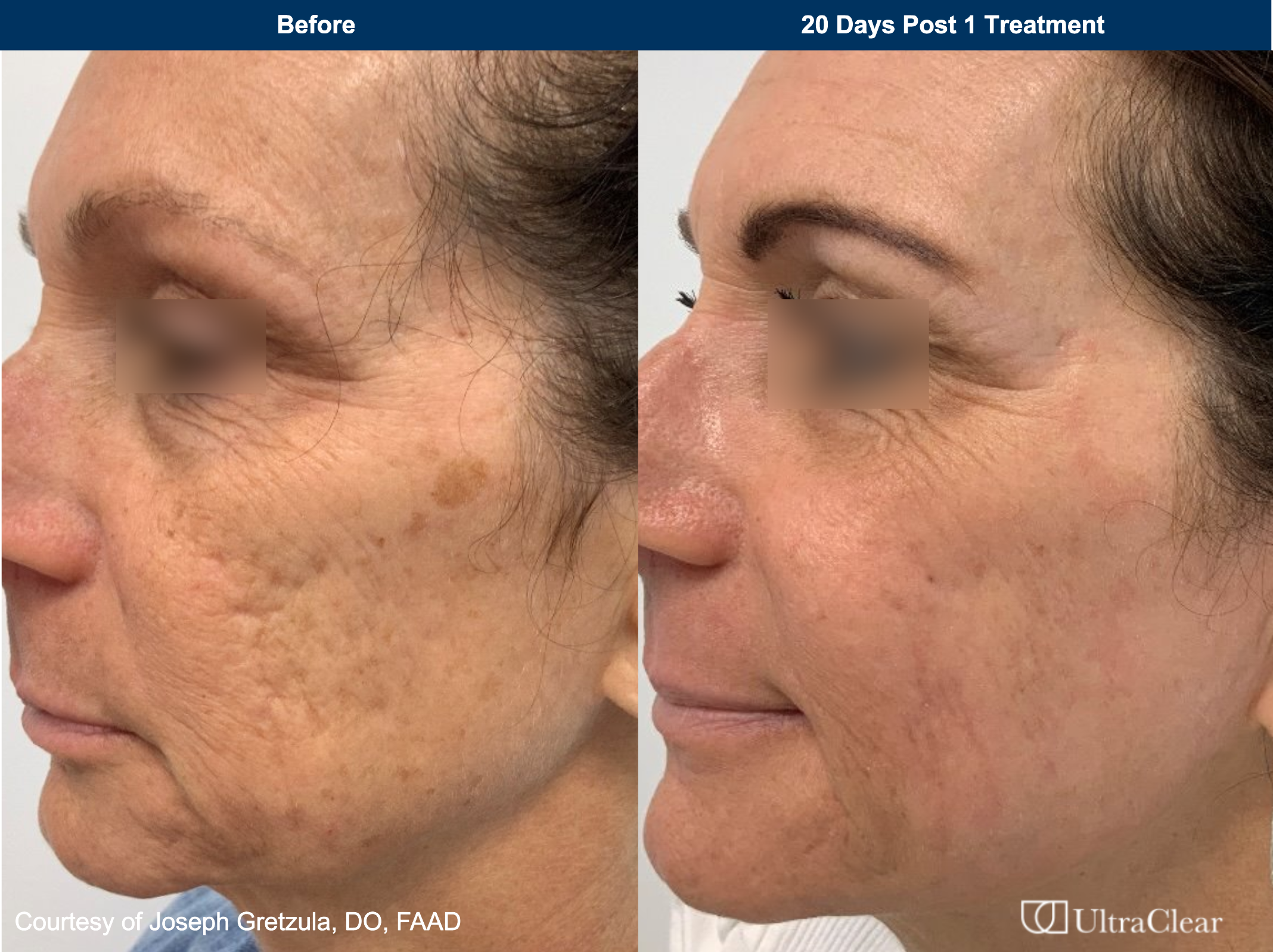 A before and after of an older white woman using UltraClear